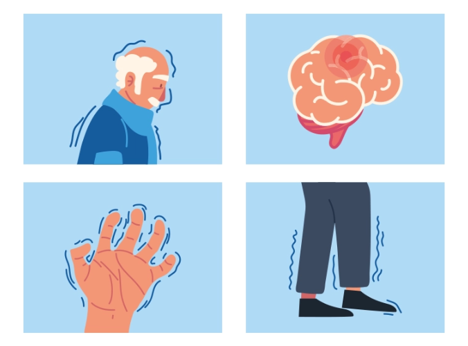 Ilustración de perfil humano, cerebro, manos y piernas con signos de Parkinson. Ilustración de perfil humano, cerebro, manos y piernas con signos de Parkinson.