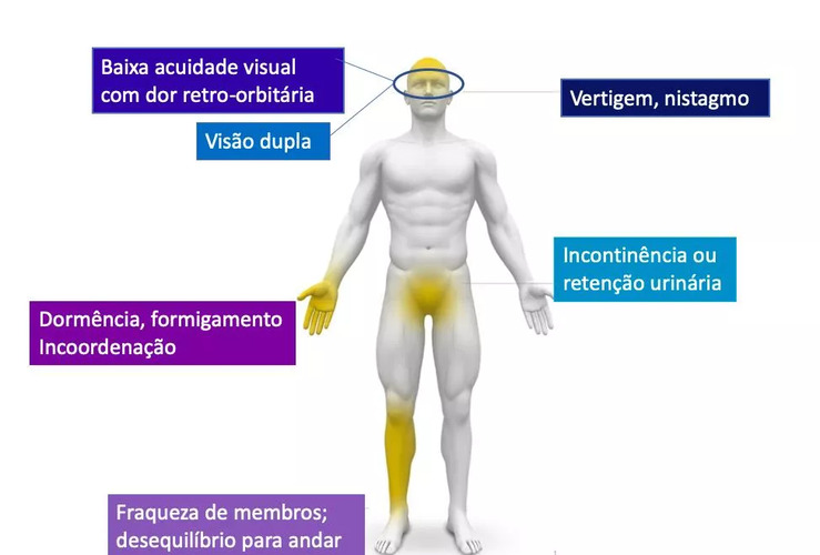 Ilustração dos sintomas e sinais da esclerose múltipla (EM): baixa acuidade visual com dor retro-orbitária; vertigem e nistagmo; visão dupla; incontinência ou retenção urinária; dormência e formigamento; incoordenação; fraqueza nos membros; e desequilíbrio ao andar. Ilustração dos sintomas e sinais da esclerose múltipla (EM): baixa acuidade visual com dor retro-orbitária; vertigem e nistagmo; visão dupla; incontinência ou retenção urinária; dormência e formigamento; incoordenação; fraqueza nos membros; e desequilíbrio ao andar.