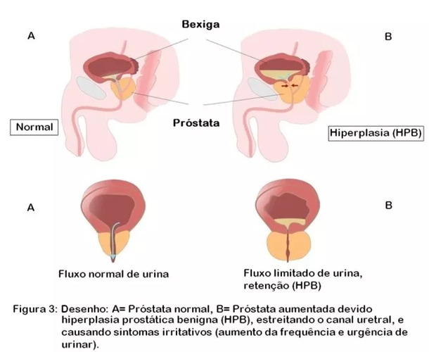 Figura 3: Desenho: A= Próstata normal, B= Próstata aumentada devido hiperplasia prostática benigna (HPB), estreitando o canal uretral, e causando sintomas irritativos (aumento da frequência e urgência de urinar). Figura 3: Desenho: A= Próstata normal, B= Próstata aumentada devido hiperplasia prostática benigna (HPB), estreitando o canal uretral, e causando sintomas irritativos (aumento da frequência e urgência de urinar).