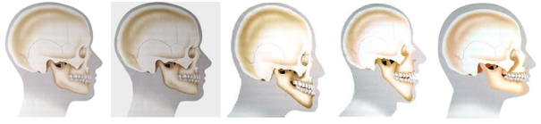 Apresenta uma sequência de perfis laterais esquemáticos que ilustram diferentes tipos de deformidades faciais. Apresenta uma sequência de perfis laterais esquemáticos que ilustram diferentes tipos de deformidades faciais.