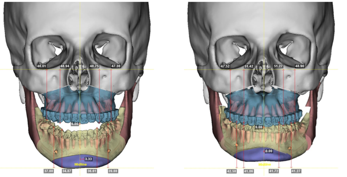 A imagem mostra uma visão frontal do crânio com medições detalhadas das estruturas ósseas. A imagem mostra uma visão frontal do crânio com medições detalhadas das estruturas ósseas.