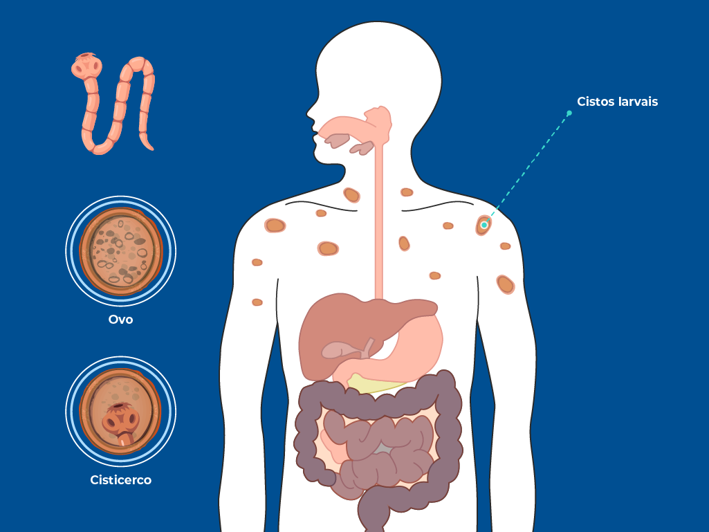 A imagem mostra o ciclo da Taenia Solium, evidenciando o ovo da tênia, a forma larval (cisticerco) e a localização de cistos larvais no corpo humano. A infecção pode causar cisticercose, com os cistos se espalhando por vários órgãos. A imagem mostra o ciclo da Taenia Solium, evidenciando o ovo da tênia, a forma larval (cisticerco) e a localização de cistos larvais no corpo humano. A infecção pode causar cisticercose, com os cistos se espalhando por vários órgãos.