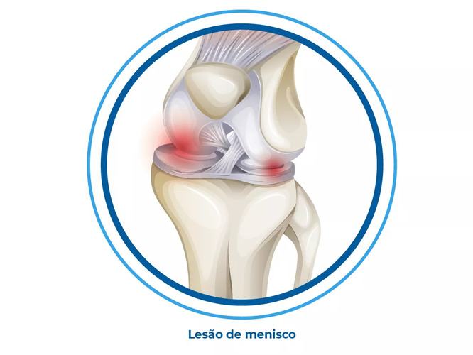 Imagem de lesão no menisco do joelho Imagem de lesão no menisco do joelho
