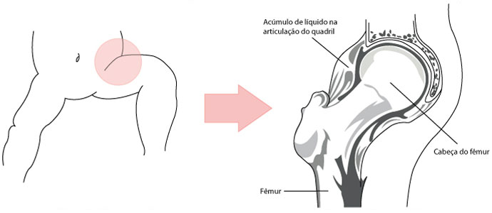 Ilustração do quadril de uma criança, que está localizado entre a bacia e a coxa, com detalhes sobre o acúmulo de líquido na articulação do quadril e indicações da localização da cabeça do osso fêmur. Ilustração do quadril de uma criança, que está localizado entre a bacia e a coxa, com detalhes sobre o acúmulo de líquido na articulação do quadril e indicações da localização da cabeça do osso fêmur.