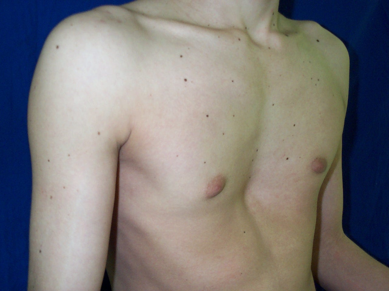 Foto frontal de uma pessoa com diagnóstico de Pectus Excavatum, que é uma deformidade da parede torácica conhecida pelos leigos como tórax em funil ou "peito de sapateiro". Foto frontal de uma pessoa com diagnóstico de Pectus Excavatum, que é uma deformidade da parede torácica conhecida pelos leigos como tórax em funil ou "peito de sapateiro".