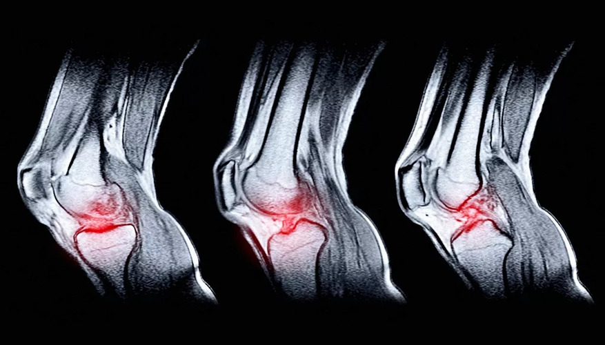 A imagem apresenta três radiografias de um tornozelo. Nas imagens existem áreas destacadas em vermelho, que indicam a ruptura do tendão de aquiles A imagem apresenta três radiografias de um tornozelo. Nas imagens existem áreas destacadas em vermelho, que indicam a ruptura do tendão de aquiles
