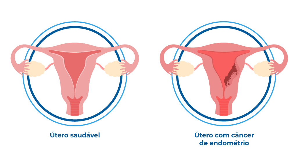 A imagem compara um útero saudável com um afetado por câncer de endométrio, destacando sintomas como dor abdominal e corrimento vaginal. A ilustração permite exemplificar a doença, a qual é um tumor maligno iniciado no revestimento interno do útero