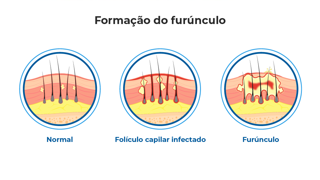 Ilustração que mostra a formação de um furúnculo em três estágios diferentes: pele normal, folículo capilar infectado e furúnculo com pus acumulado. A imagem destaca as camadas da pele e o processo inflamatório. Ilustração que mostra a formação de um furúnculo em três estágios diferentes: pele normal, folículo capilar infectado e furúnculo com pus acumulado. A imagem destaca as camadas da pele e o processo inflamatório.