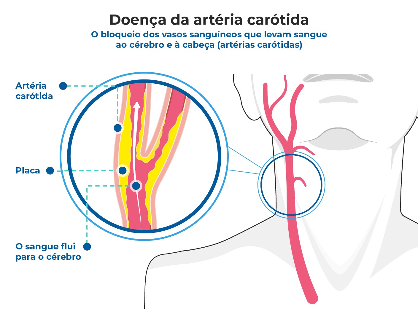 Doença aterosclerótica carotídea: sintomas, tratamento e prevenção ...
