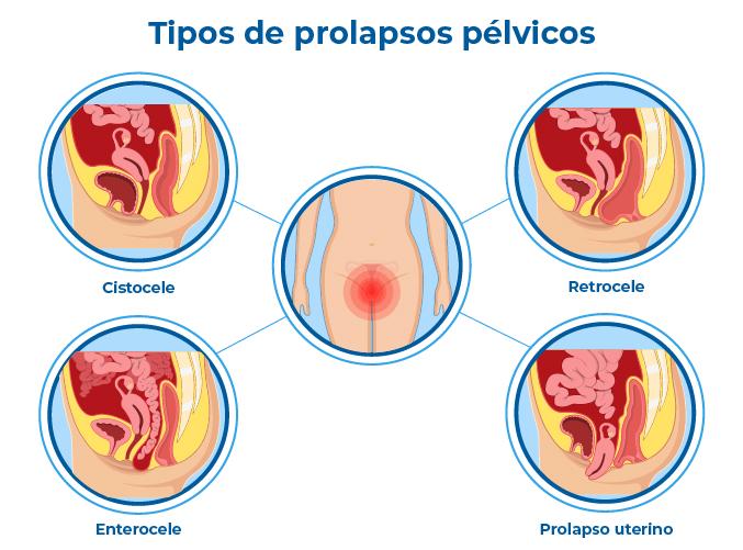 Ilustração dos tipos de prolapso genital: prolapso de bexiga (cistocele), retocele, enterocele e prolapso uterino, comuns após partos vaginais, constipação crônica ou menopausa. Ilustração dos tipos de prolapso genital: prolapso de bexiga (cistocele), retocele, enterocele e prolapso uterino, comuns após partos vaginais, constipação crônica ou menopausa.