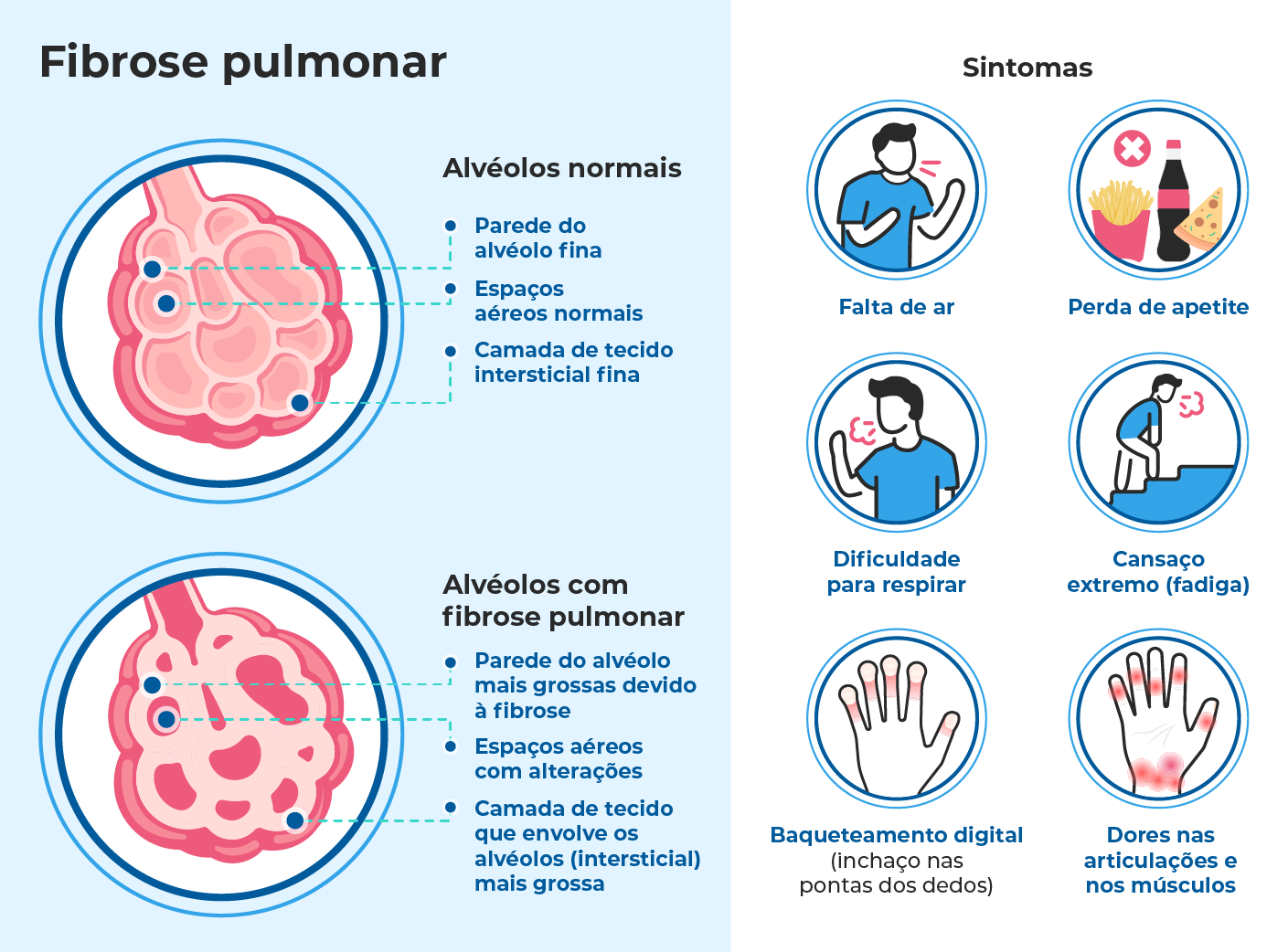 Ilustração médica que mostra pulmões normais e com fibrose pulmonar. Em destaque, os sintomas como falta de ar, perda de peso, cansaço extremo, dores musculares e alterações nos alvéolos pulmonares. Ilustração médica que mostra pulmões normais e com fibrose pulmonar. Em destaque, os sintomas como falta de ar, perda de peso, cansaço extremo, dores musculares e alterações nos alvéolos pulmonares.