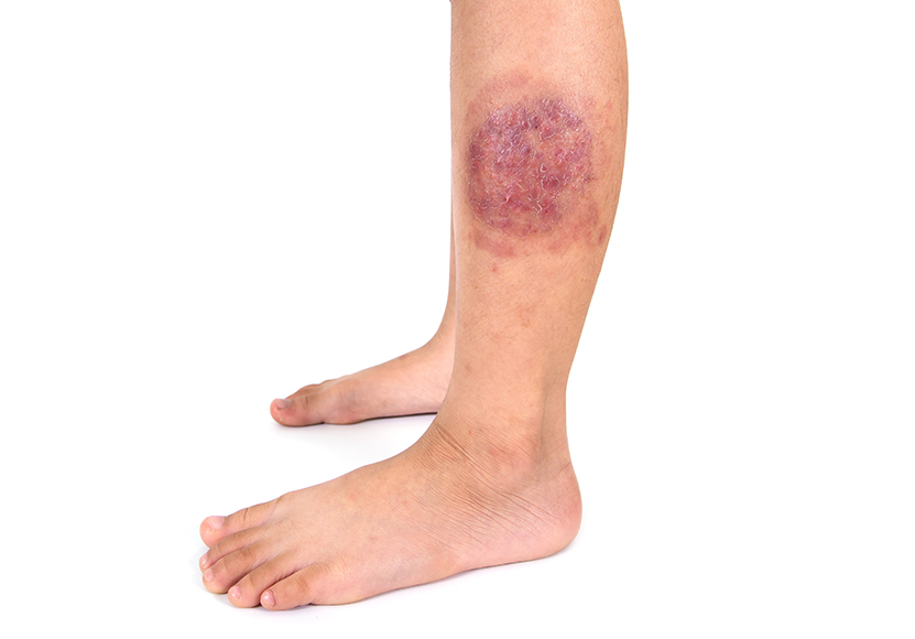 Imagem que mostra uma mancha na perna, abaixo do joelho, representa o sintoma de dermatofitose, um tipo de micose de pele. Imagem que mostra uma mancha na perna, abaixo do joelho, representa o sintoma de dermatofitose, um tipo de micose de pele.