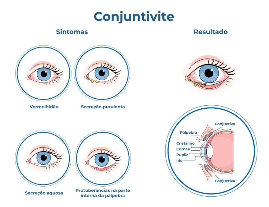 Conjuntivite: Sintomas, Causas e Tratamentos
