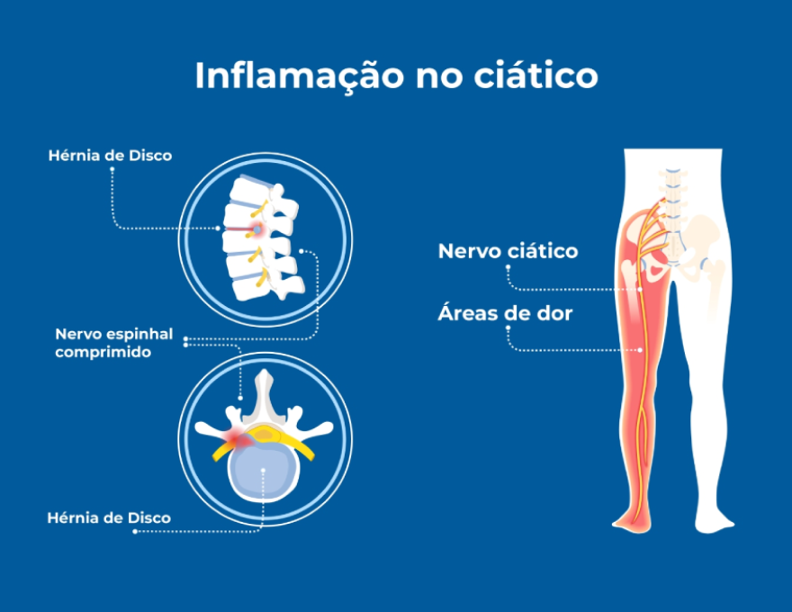 Imagem ilustrativa do nervo ciático comprimido, o que causa inflamação no nervo ciático e dor na perna. O infográfico apoia a explicação das causas, sintomas e como tratar a inflamação no nervo ciático. Imagem ilustrativa do nervo ciático comprimido, o que causa inflamação no nervo ciático e dor na perna. O infográfico apoia a explicação das causas, sintomas e como tratar a inflamação no nervo ciático.