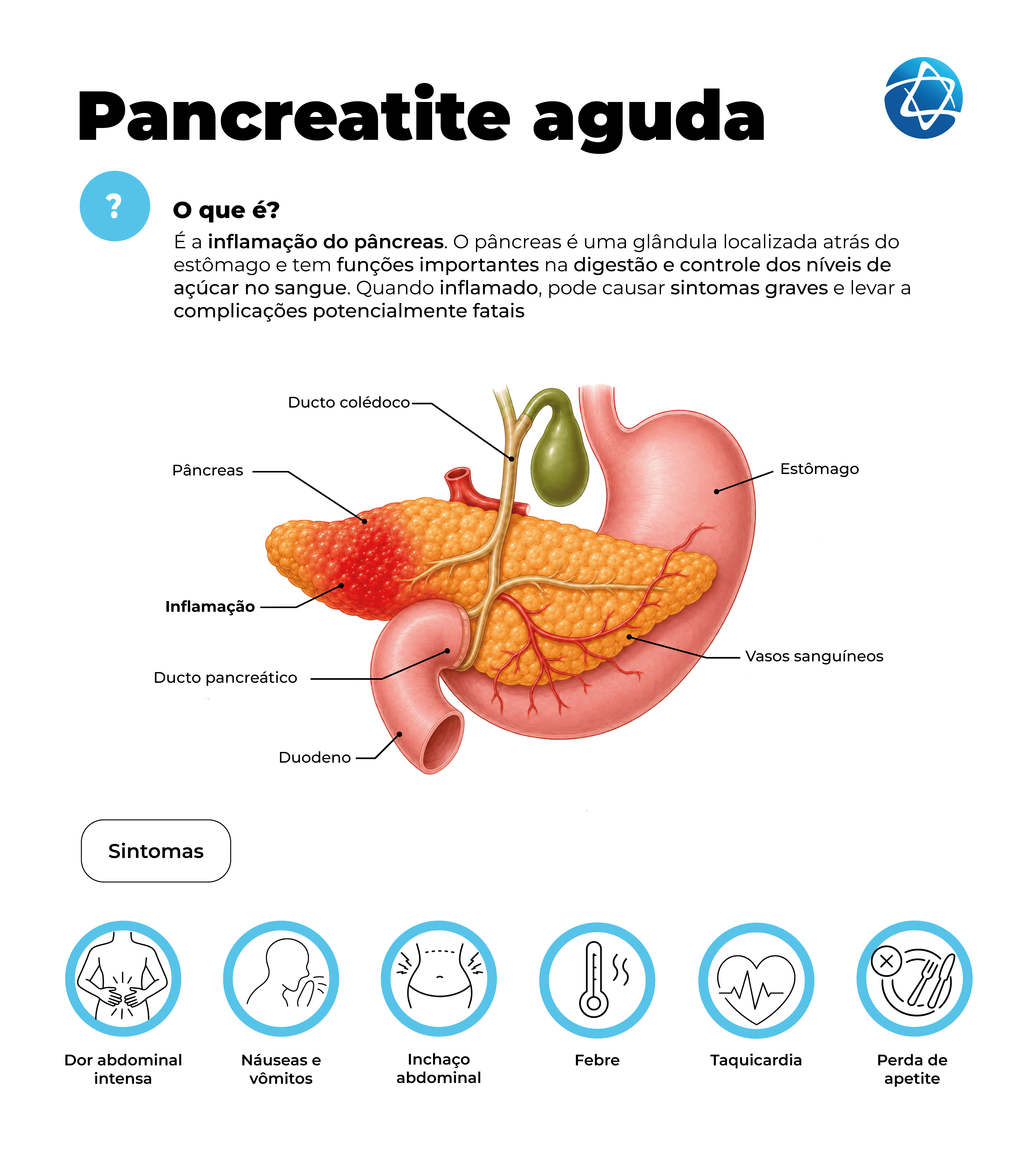 Infográfico sobre pancreatite aguda, explicando que é a inflamação do pâncreas, órgão localizado atrás do estômago e importante para a digestão e controle do açúcar no sangue. A imagem mostra o pâncreas inflamado e estruturas próximas, como estômago, duodeno, ductos e vasos sanguíneos. Também destaca sintomas comuns, como dor abdominal intensa, náuseas, vômitos, inchaço abdominal, febre, taquicardia e perda de apetite. Infográfico sobre pancreatite aguda, explicando que é a inflamação do pâncreas, órgão localizado atrás do estômago e importante para a digestão e controle do açúcar no sangue. A imagem mostra o pâncreas inflamado e estruturas próximas, como estômago, duodeno, ductos e vasos sanguíneos. Também destaca sintomas comuns, como dor abdominal intensa, náuseas, vômitos, inchaço abdominal, febre, taquicardia e perda de apetite.