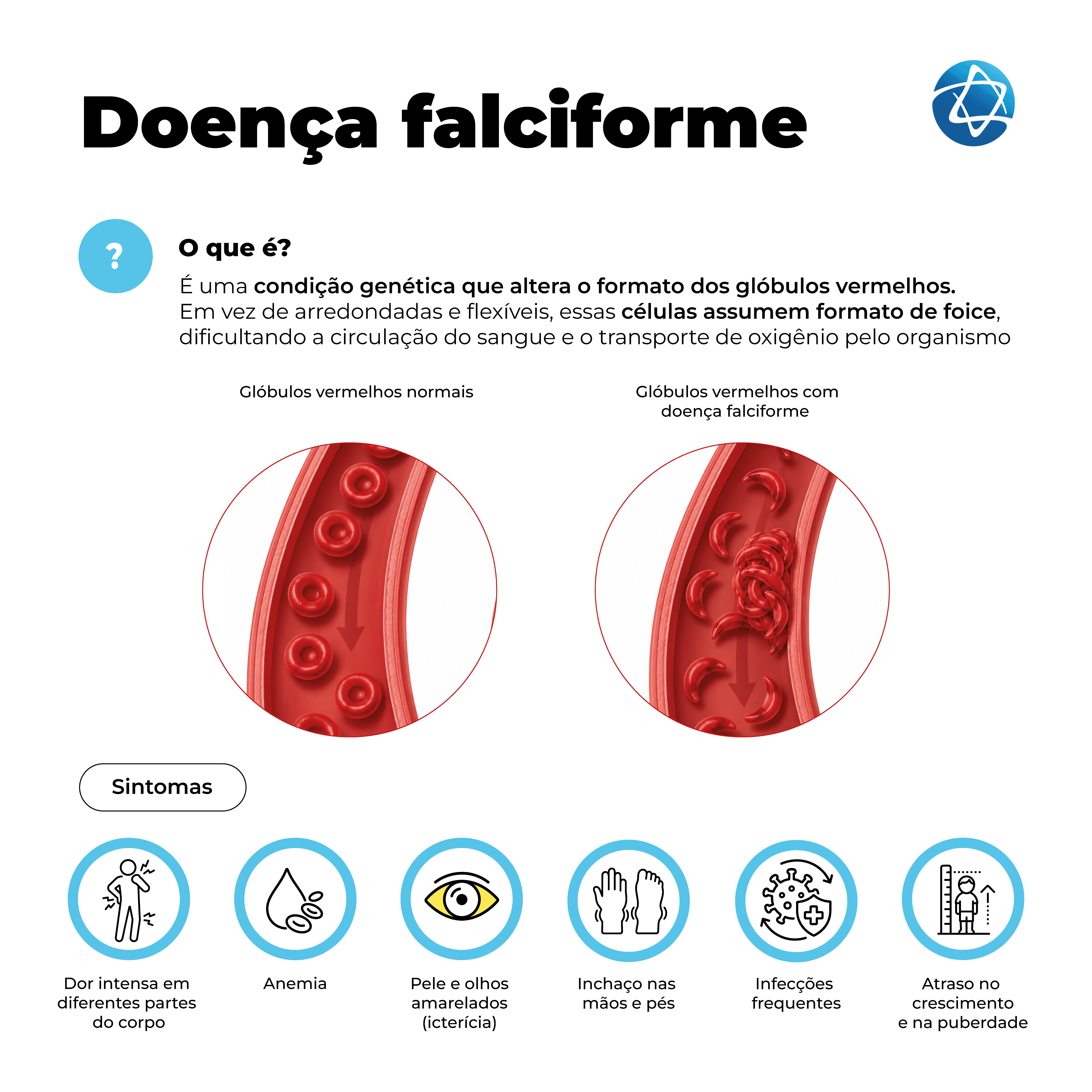 Infográfico sobre doença falciforme explicando que é uma condição genética que altera o formato dos glóbulos vermelhos, dificultando a circulação do sangue e o transporte de oxigênio. Compara glóbulos vermelhos normais e em formato de foice, além de sintomas como dor intensa, anemia, icterícia, inchaço nas mãos e pés, infecções frequentes e atraso no crescimento. Infográfico sobre doença falciforme explicando que é uma condição genética que altera o formato dos glóbulos vermelhos, dificultando a circulação do sangue e o transporte de oxigênio. Compara glóbulos vermelhos normais e em formato de foice, além de sintomas como dor intensa, anemia, icterícia, inchaço nas mãos e pés, infecções frequentes e atraso no crescimento.