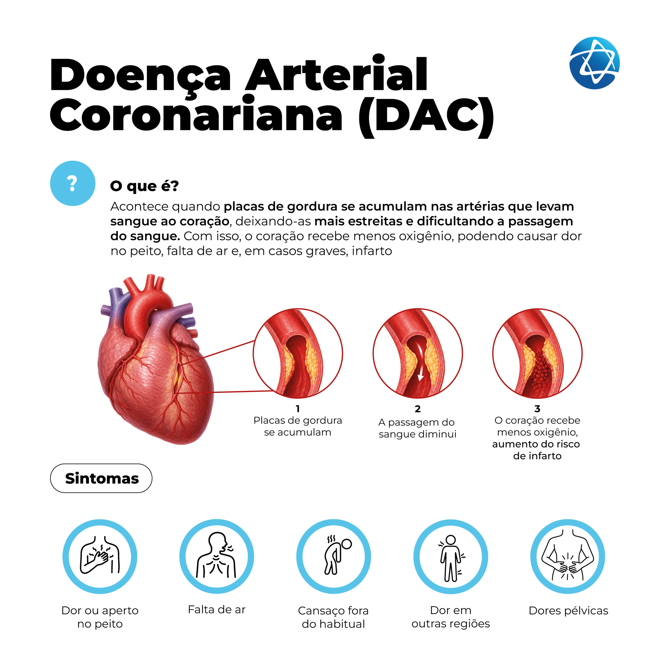 Infográfico sobre doença arterial coronariana explicando que placas de gordura se acumulam nas artérias que levam sangue ao coração, estreitando os vasos e reduzindo a passagem do sangue. Mostra o aumento do risco de infarto e sintomas como dor ou aperto no peito, falta de ar, cansaço fora do habitual, dor em outras regiões e dores pélvicas. Infográfico sobre doença arterial coronariana explicando que placas de gordura se acumulam nas artérias que levam sangue ao coração, estreitando os vasos e reduzindo a passagem do sangue. Mostra o aumento do risco de infarto e sintomas como dor ou aperto no peito, falta de ar, cansaço fora do habitual, dor em outras regiões e dores pélvicas.
