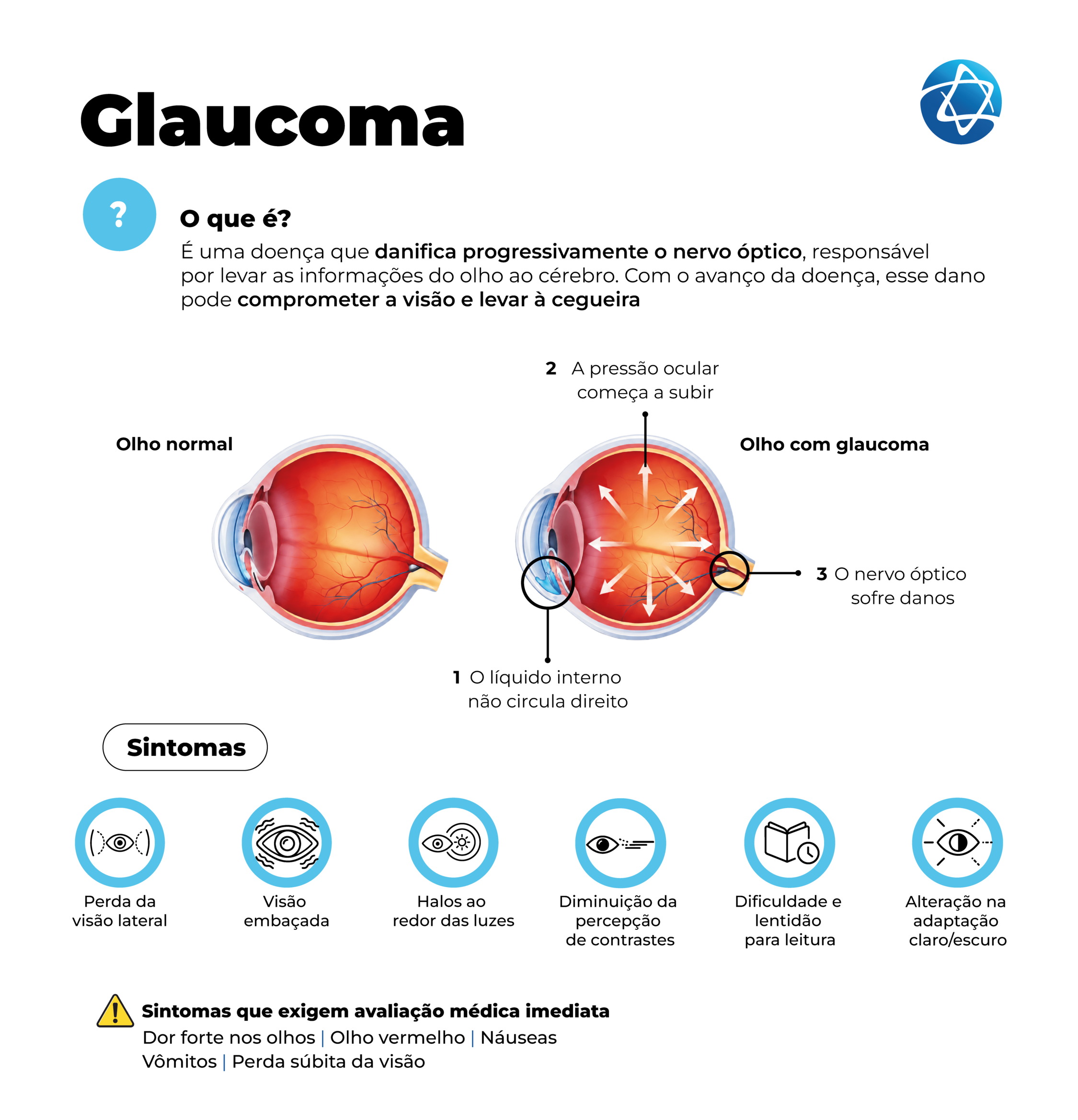 Infográfico sobre glaucoma explicando que a doença danifica progressivamente o nervo óptico e pode comprometer a visão. Compara olho normal e olho com glaucoma, mostrando aumento da pressão ocular e danos no nervo óptico, além de sintomas como perda da visão lateral, visão embaçada, halos ao redor das luzes e dificuldade para leitura. Infográfico sobre glaucoma explicando que a doença danifica progressivamente o nervo óptico e pode comprometer a visão. Compara olho normal e olho com glaucoma, mostrando aumento da pressão ocular e danos no nervo óptico, além de sintomas como perda da visão lateral, visão embaçada, halos ao redor das luzes e dificuldade para leitura.