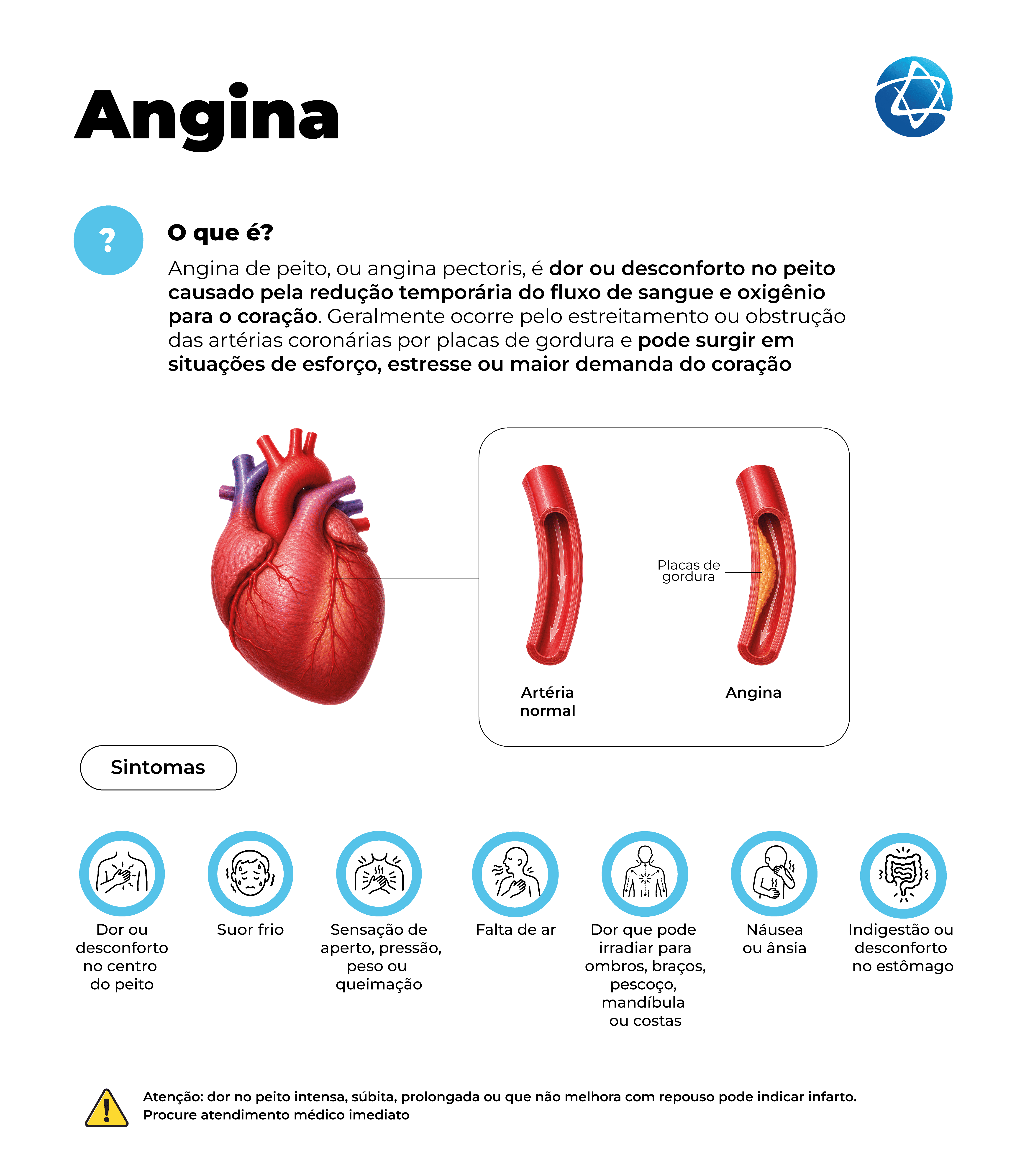Infográfico sobre angina explicando que o desconforto no peito ocorre pela redução temporária do fluxo de sangue e oxigênio para o coração, geralmente causada pelo estreitamento das artérias coronárias por placas de gordura. Mostra sintomas como suor frio, falta de ar, náusea, indigestão e dor que pode irradiar para ombros, braços, pescoço, mandíbula ou costas Infográfico sobre angina explicando que o desconforto no peito ocorre pela redução temporária do fluxo de sangue e oxigênio para o coração, geralmente causada pelo estreitamento das artérias coronárias por placas de gordura. Mostra sintomas como suor frio, falta de ar, náusea, indigestão e dor que pode irradiar para ombros, braços, pescoço, mandíbula ou costas