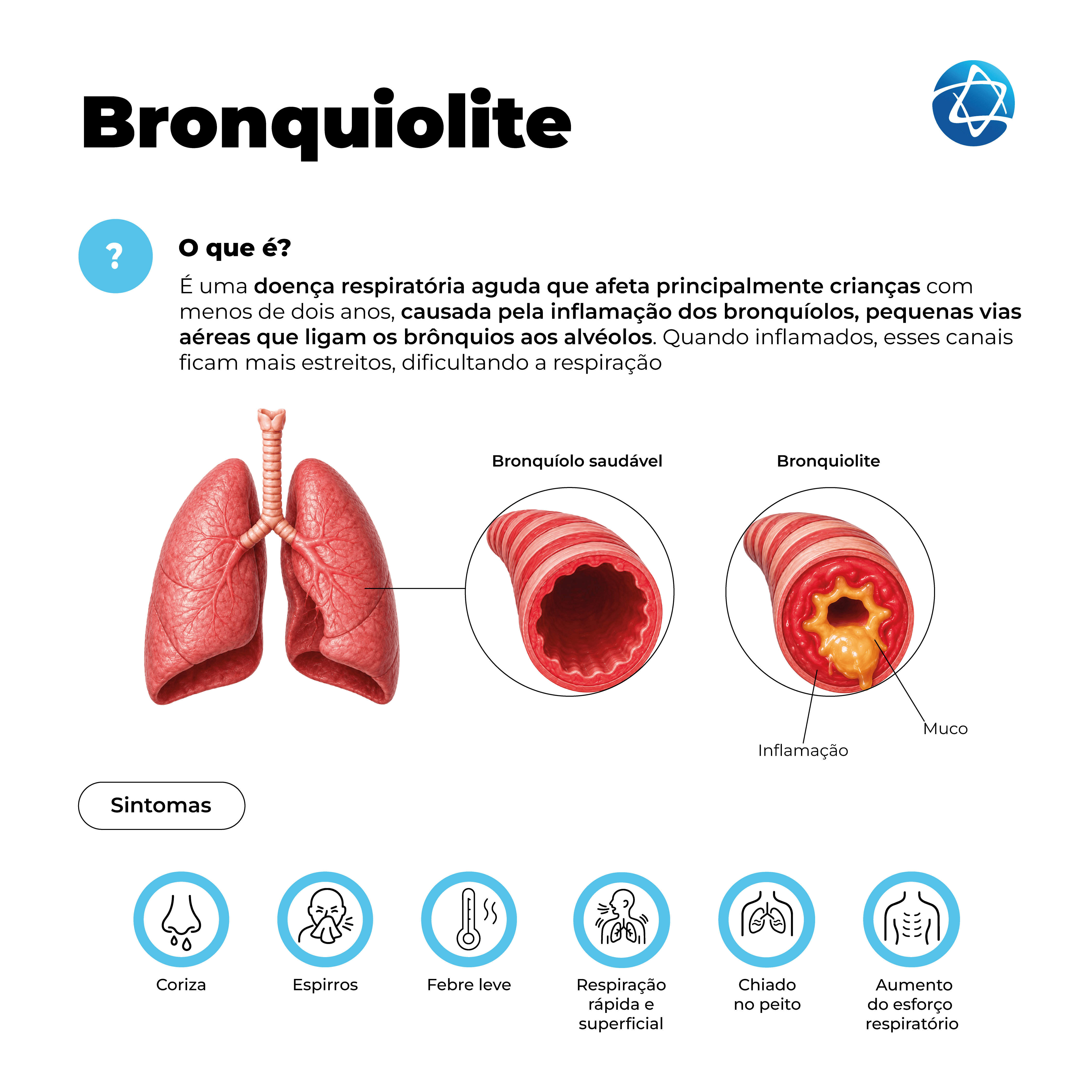 Infográfico sobre bronquiolite explicando que é uma doença respiratória aguda que afeta principalmente crianças menores de dois anos, causada pela inflamação dos bronquíolos. Compara bronquíolo saudável e bronquiolite, com inflamação e muco, além de sintomas como coriza, espirros, febre leve, respiração rápida e superficial, chiado no peito e aumento do esforço respiratório. Infográfico sobre bronquiolite explicando que é uma doença respiratória aguda que afeta principalmente crianças menores de dois anos, causada pela inflamação dos bronquíolos. Compara bronquíolo saudável e bronquiolite, com inflamação e muco, além de sintomas como coriza, espirros, febre leve, respiração rápida e superficial, chiado no peito e aumento do esforço respiratório.