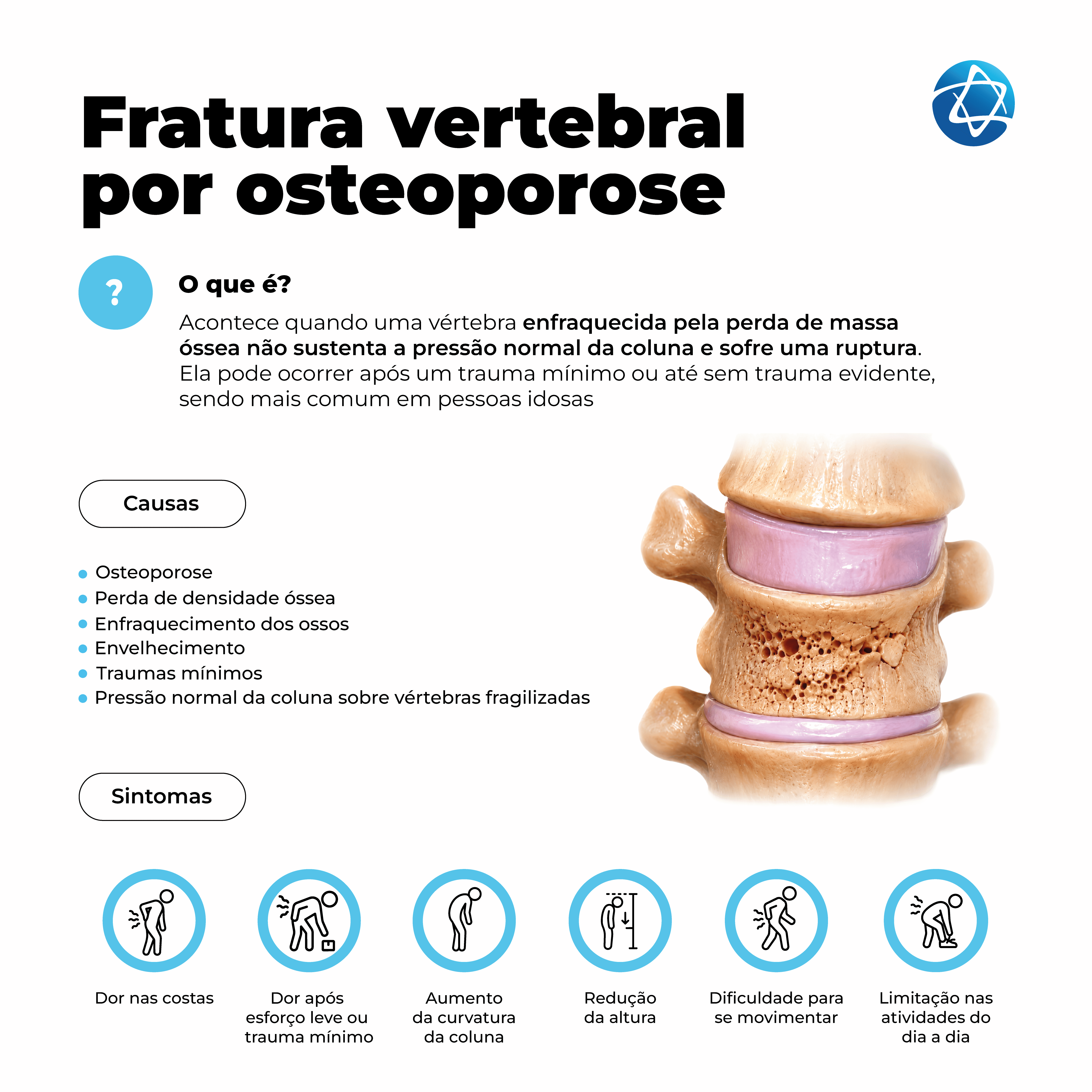 Infográfico sobre fratura vertebral por osteoporose explicando que ocorre quando uma vértebra enfraquecida pela perda de massa óssea sofre ruptura. Apresenta causas como osteoporose, perda de densidade óssea, envelhecimento e traumas mínimos, além de sintomas como dor nas costas, aumento da curvatura da coluna, redução da altura, dificuldade para se movimentar e limitação nas atividades do dia a dia. Infográfico sobre fratura vertebral por osteoporose explicando que ocorre quando uma vértebra enfraquecida pela perda de massa óssea sofre ruptura. Apresenta causas como osteoporose, perda de densidade óssea, envelhecimento e traumas mínimos, além de sintomas como dor nas costas, aumento da curvatura da coluna, redução da altura, dificuldade para se movimentar e limitação nas atividades do dia a dia.