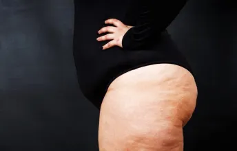 Pessoa com excesso de gordura corporal visível, representa os sintomas da obesidade como acúmulo de gordura no corpo e aumento do peso corporal, fatores que afetam a saúde e exigem atenção médica.