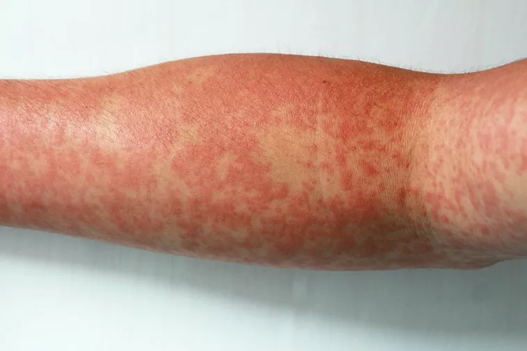Erupcoes Cutaneas De Dengue Entendendo Os Sintomas Da Dengue: