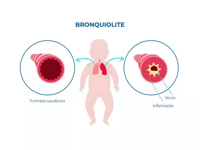 Bronquiolite: Sintomas, Causas e Tratamentos