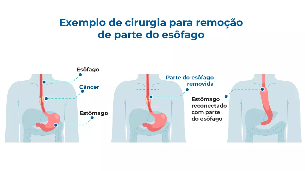 Câncer de esôfago: Sintomas, Causas e Tratamentos