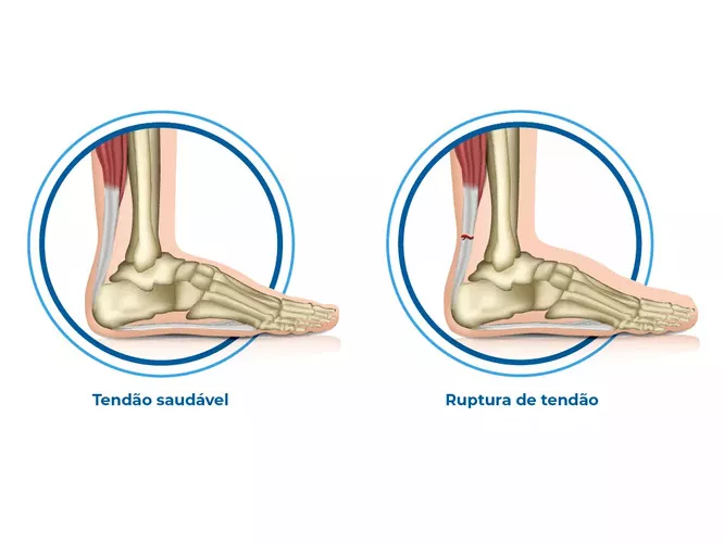Ruptura de tendão: Sintomas, Causas e Tratamentos
